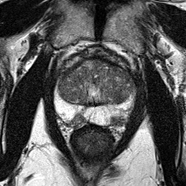 Peripheral-zone lesion, apex (Case 77) T2 axial source preview