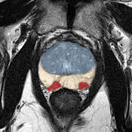 Peripheral-zone lesion, apex (Case 77) MRI preview