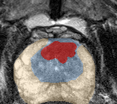 Transition-zone lesion, apex (Case 80) lesion zoom preview