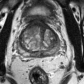 Normal gland anatomy, no lesion (Case 81) T2 axial source preview