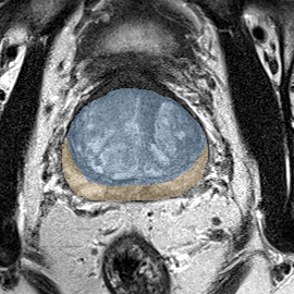 Normal gland anatomy, no lesion (Case 81) MRI preview
