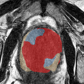 Transition-zone lesion, mid-gland (Case 82) MRI preview