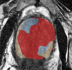 Transition-zone lesion, mid-gland (Case 82) lesion zoom preview