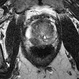Peripheral-zone lesion, mid-gland (Case 83) T2 axial source preview