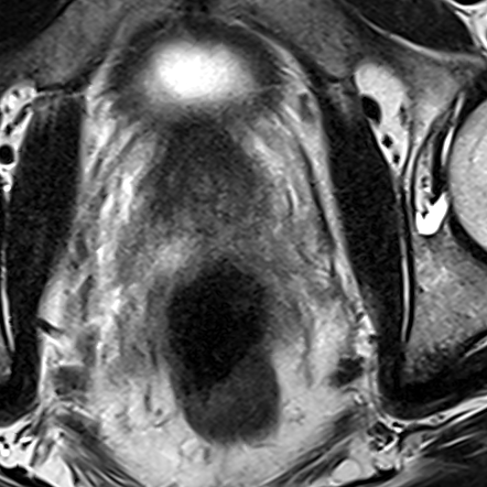 Normal gland anatomy, no lesion (Case 84) T2 axial source preview