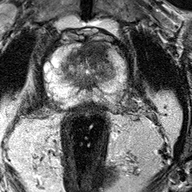 Transition-zone lesion, apex (Case 85) T2 axial source preview