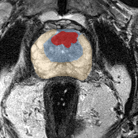 Transition-zone lesion, apex (Case 85) MRI preview