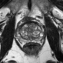 Normal gland anatomy, no lesion (Case 86) T2 axial source preview