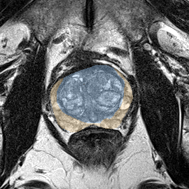 Normal gland anatomy, no lesion (Case 86) MRI preview