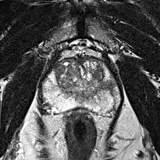 Peripheral-zone lesion, apex (Case 87) T2 axial source preview