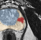 Peripheral-zone lesion, apex (Case 87) lesion zoom preview