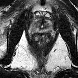 Peripheral-zone lesion, apex (Case 88) T2 axial source preview