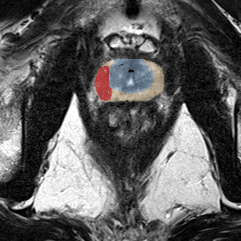 Peripheral-zone lesion, apex (Case 88) MRI preview
