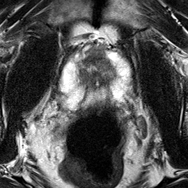 Transition-zone lesion, mid-gland (Case 89) T2 axial source preview