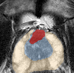 Transition-zone lesion, mid-gland (Case 89) lesion zoom preview