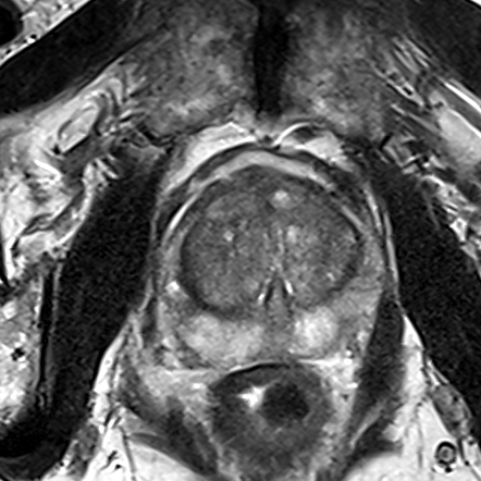 Normal gland anatomy, no lesion (Case 90) T2 axial source preview