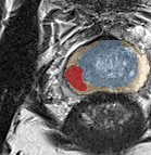 Peripheral-zone lesion, base (Case 91) lesion zoom preview