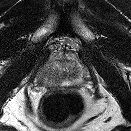 Peripheral-zone lesion, apex (Case 92) T2 axial source preview