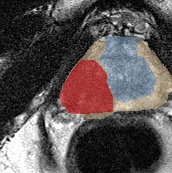 Peripheral-zone lesion, apex (Case 92) lesion zoom preview