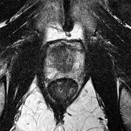 Transition-zone lesion, apex (Case 93) T2 axial source preview