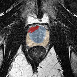 Transition-zone lesion, apex (Case 93) MRI preview