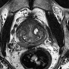 Normal gland anatomy, no lesion (Case 94) T2 axial source preview
