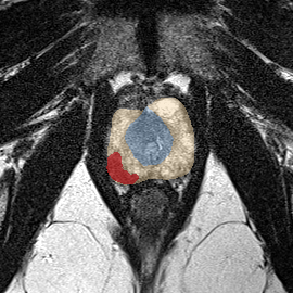 Peripheral-zone lesion, apex (Case 95) MRI preview