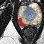 Peripheral-zone lesion, apex (Case 95) lesion zoom preview