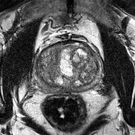 Peripheral-zone lesion, mid-gland (Case 96) T2 axial source preview