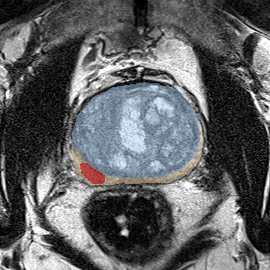 Peripheral-zone lesion, mid-gland (Case 96) MRI preview