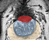 Transition-zone lesion, mid-gland (Case 97) lesion zoom preview