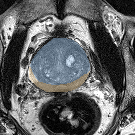 Normal gland anatomy, no lesion (Case 98) MRI preview