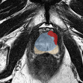 Transition-zone lesion, apex (Case 100) MRI preview
